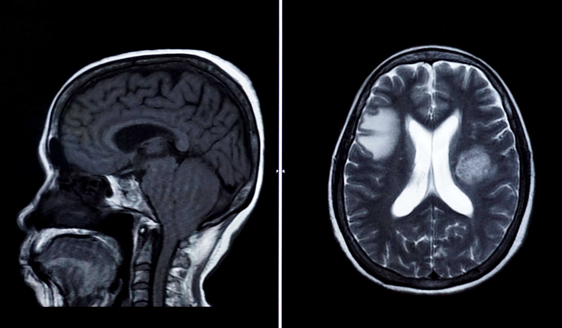 How ReVasca and GlycoCheck Support Traumatic Brain Injury (TBI) Recovery