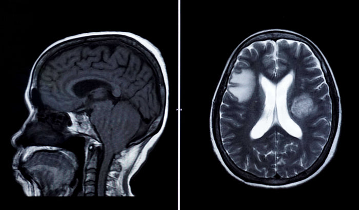 How ReVasca and GlycoCheck Support Traumatic Brain Injury (TBI) Recovery