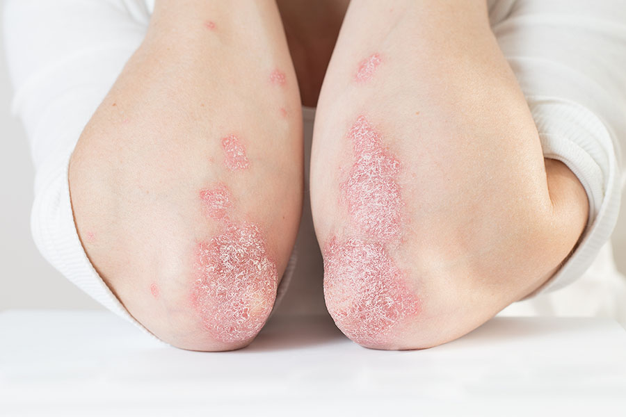 Study Links Glycocalyx Health with Psoriasis